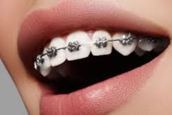 Orthodontic Treatments