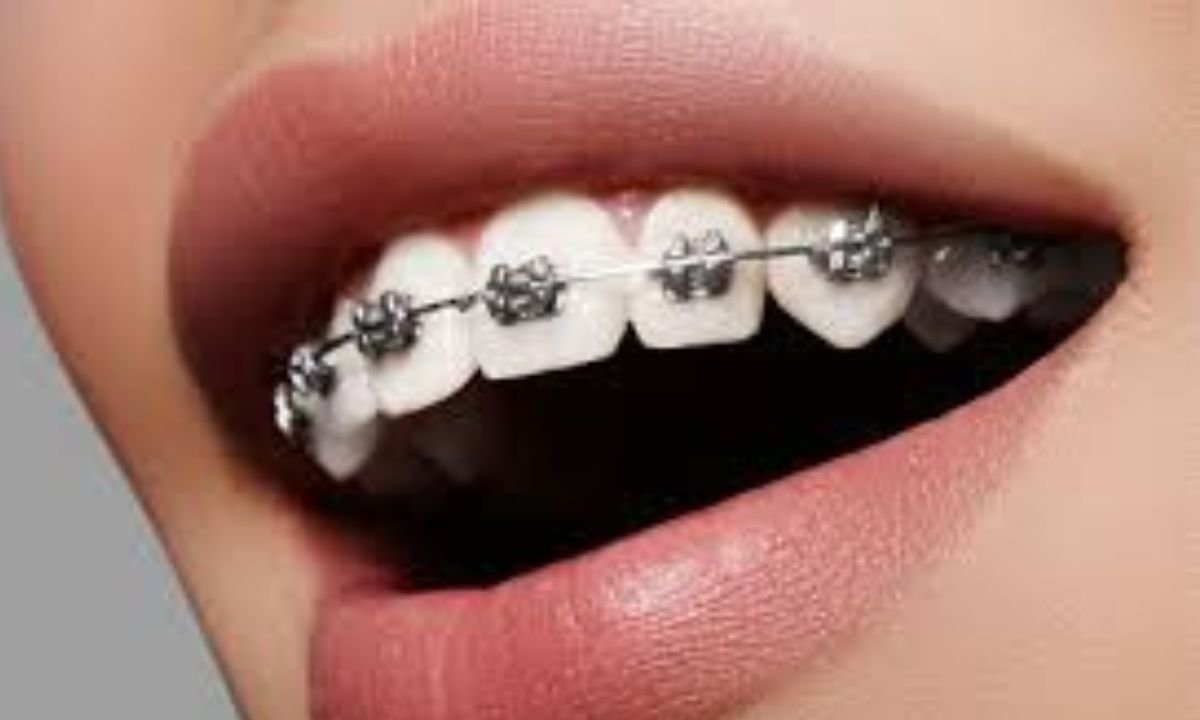 Orthodontic Treatments