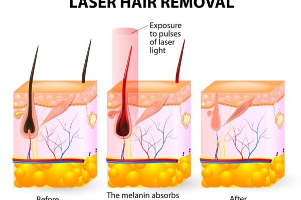 Laser Hair Removal